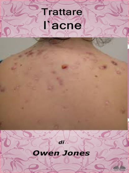 Trattare L'Acne