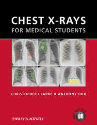 Chest X-rays for Medical Students